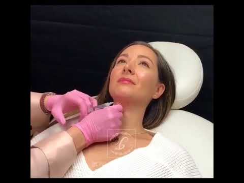 Kybella Treatment for Beautiful Bridal Photos | Monica Bonakdar MD | Newport Beach CA