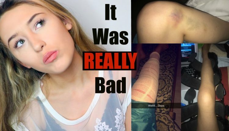 Why I Missed 6 Months of School.. My Accident : STORYTIME *graphic images*