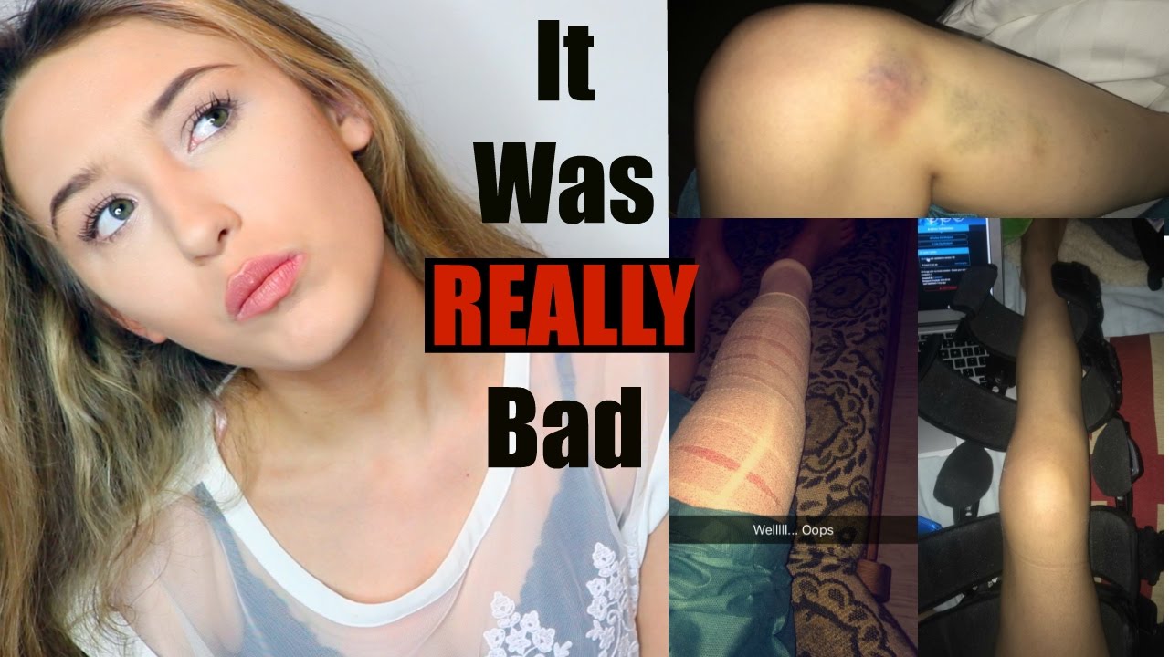 Why I Missed 6 Months of School.. My Accident : STORYTIME *graphic images*